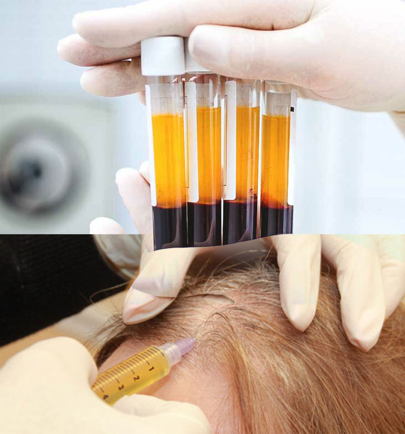 درمان ریزش و کم پشتی مو با روش PRP