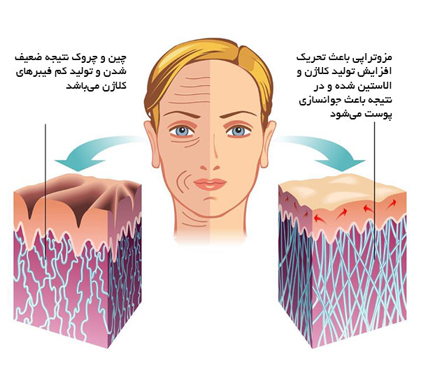 مزوتراپی چگونه باعث جوانسازی پوست می شود؟